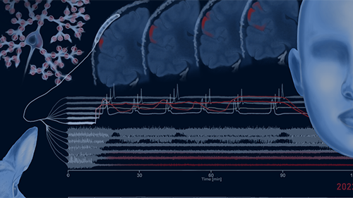 Link to 'EBio2: Taming the Hidden "Brain Tsunamis" that Follow Severe Head Injuries'